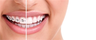 10 Reasons Why Invisalign is the right choice
