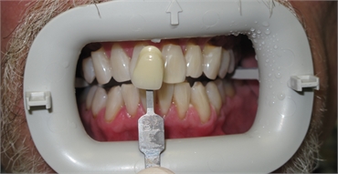 Whitening After 703 753 8600 Dentist Gainesville VA