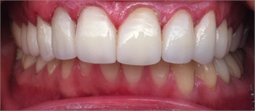 Aligned Teeth After Retracted 703 753 8600 Dentist Gainesville VA