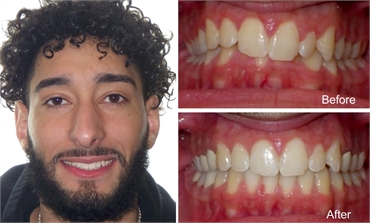 Male 21 Years Old with Overbite Before and After Invisalign Treatment