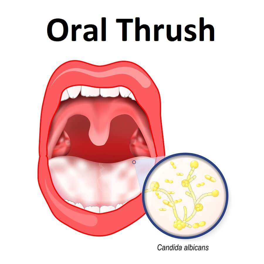 The ultimate guide to treating oral thrush | News | Dentagama