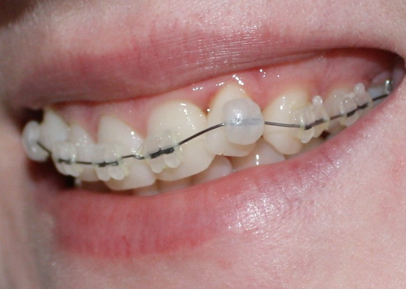 wax for braces