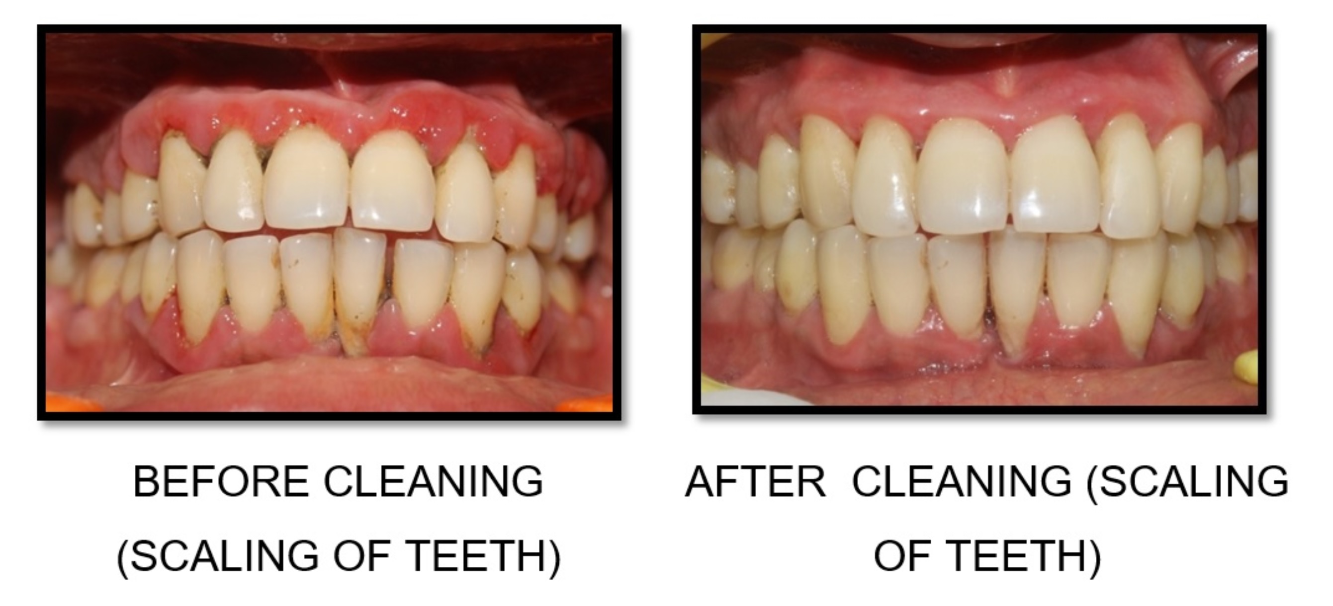 Meaning teeth scaling Ask Well: