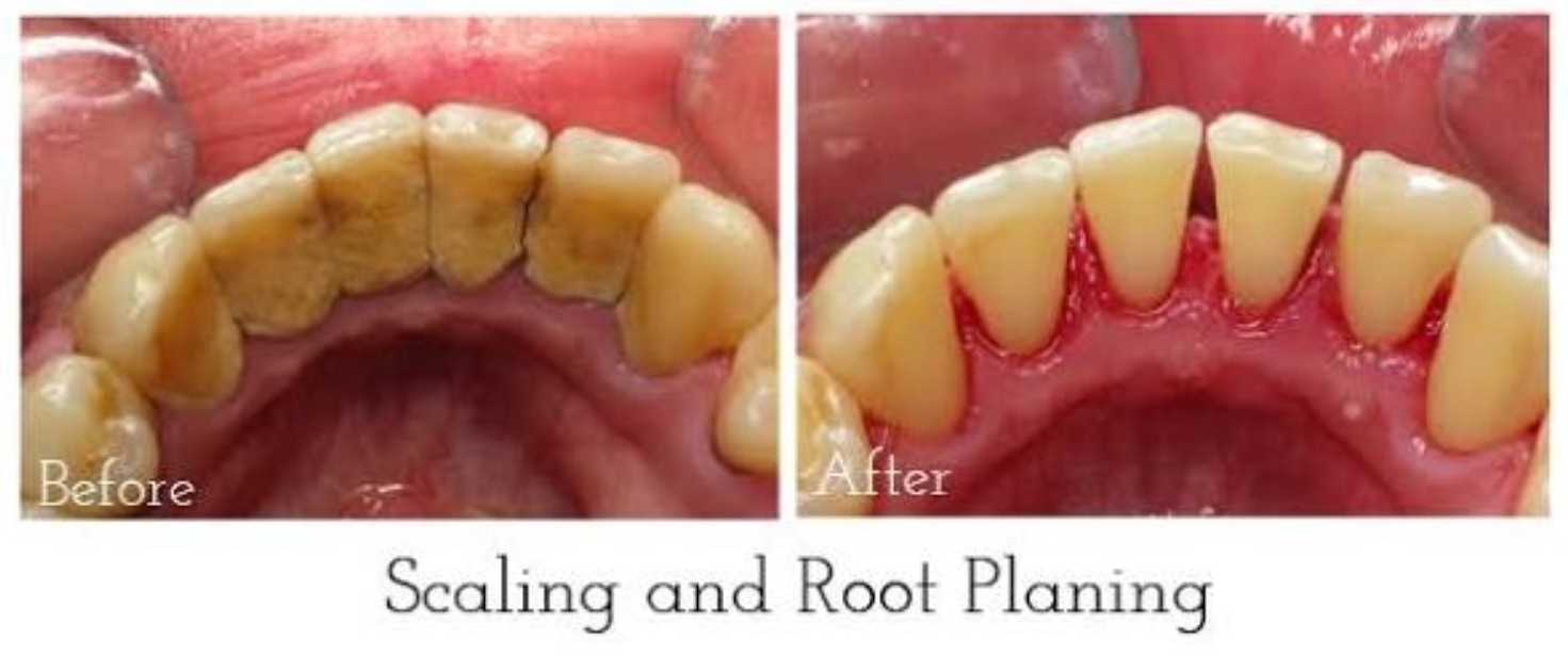 teeth-scaling-procedure-news-dentagama