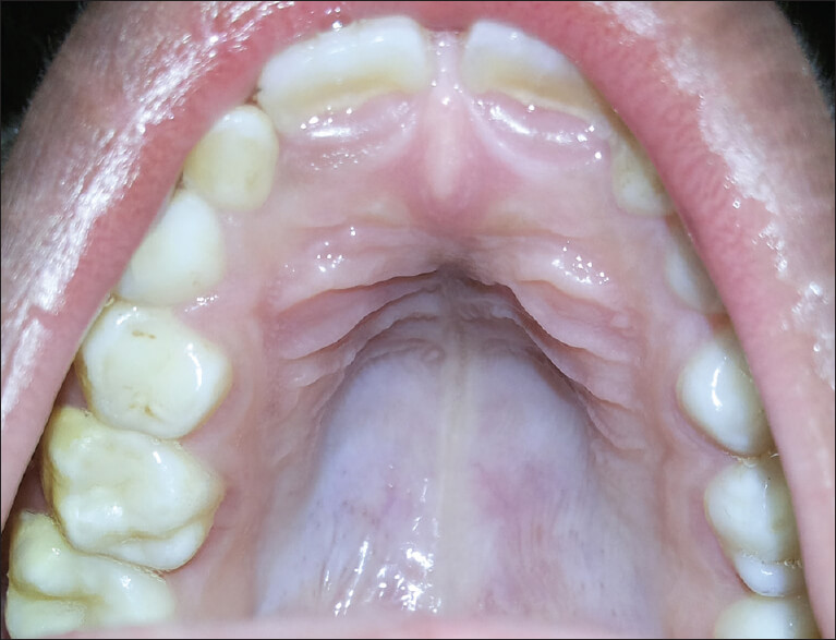 High-arched palate - Gothic palate - Noonan syndrome - Causes - Diagnosis - Treatment - Homeopathic - Best Homeopathic doctor - Dr Qaisar Ahmed MD, DHMS