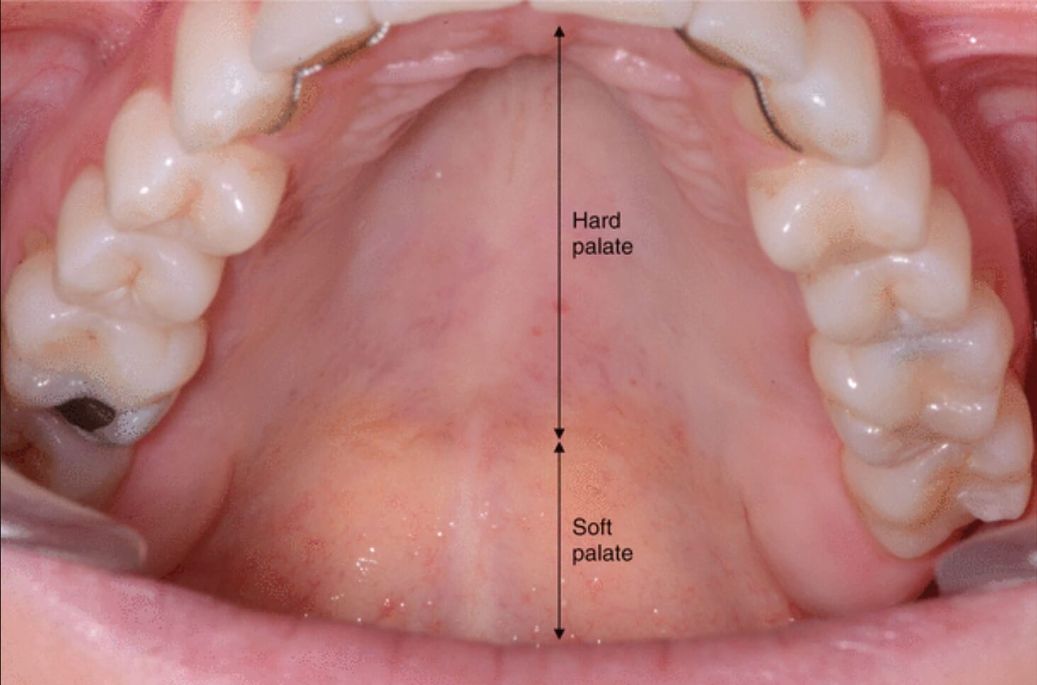 What Is High arched Palate Or Gothic Palate News Dentagama