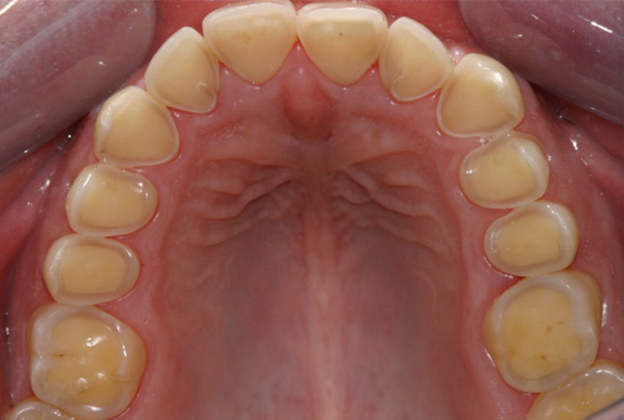 Erosion Teeth