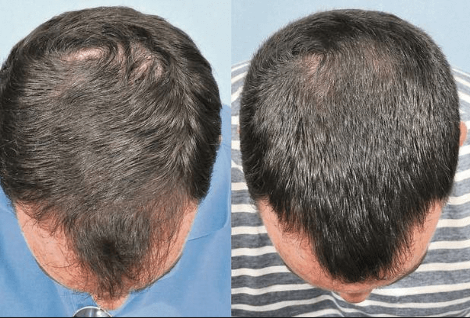 Можно ли восстановить волосы после себорейной алопеции