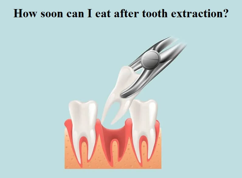 How Soon Can I Eat After Tooth Extraction News Dentagama