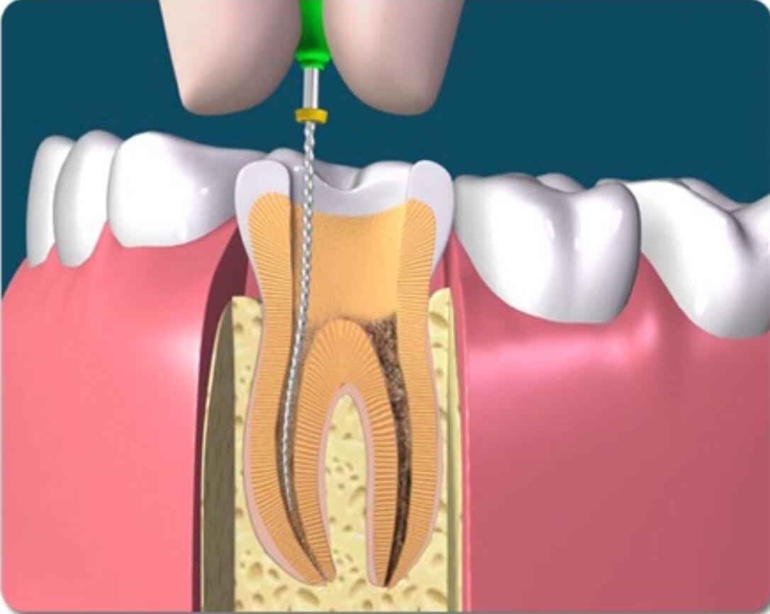 Прочистка каналов зуба