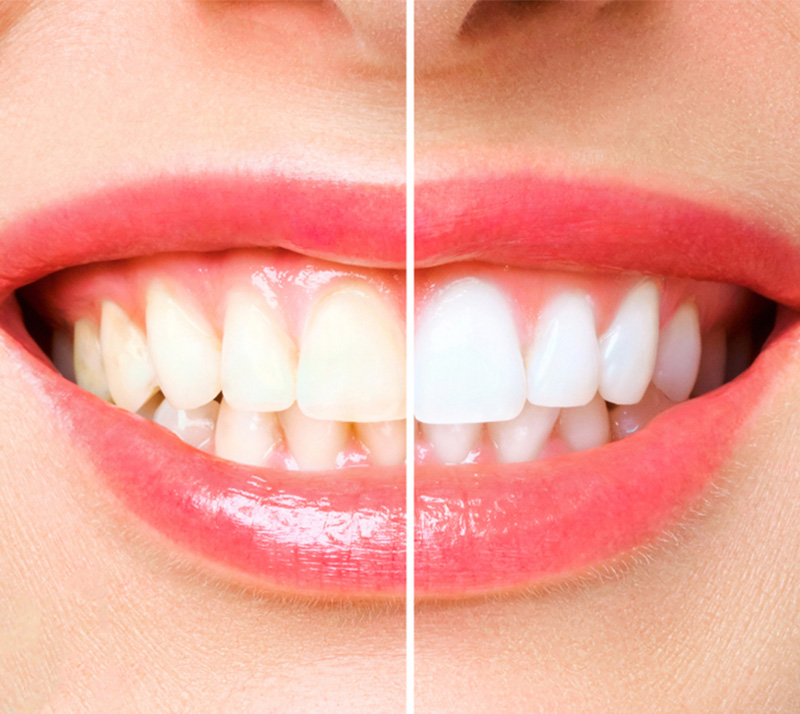 Teeth whitening dentist northern ireland