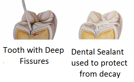 Dental Periodontal Illness Linked To Coronary heart Illness And Untimely Births