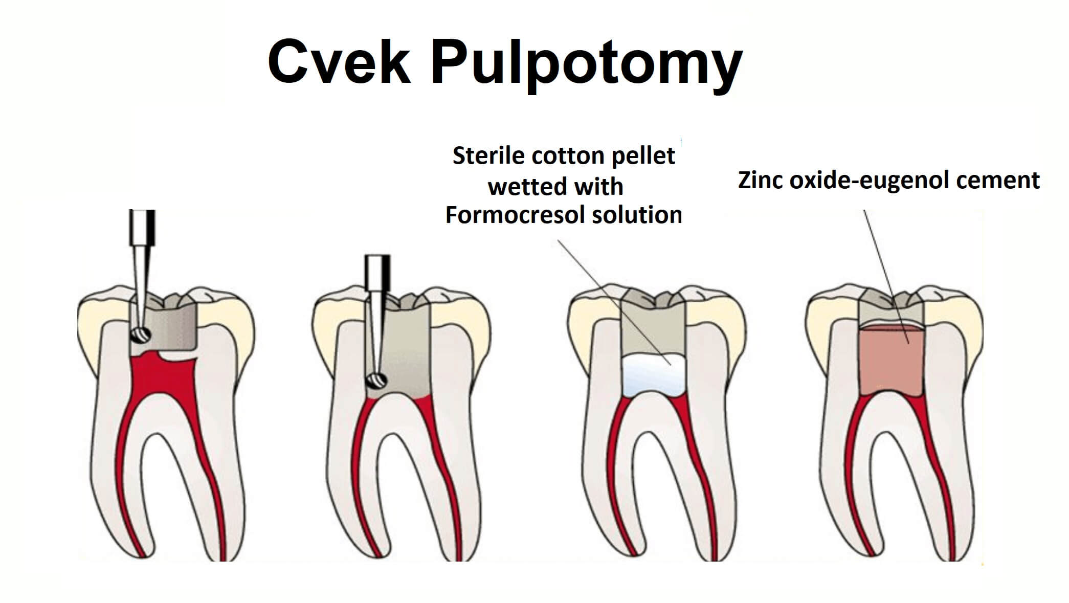What Is Cvek Pulpotomy News Dentagama