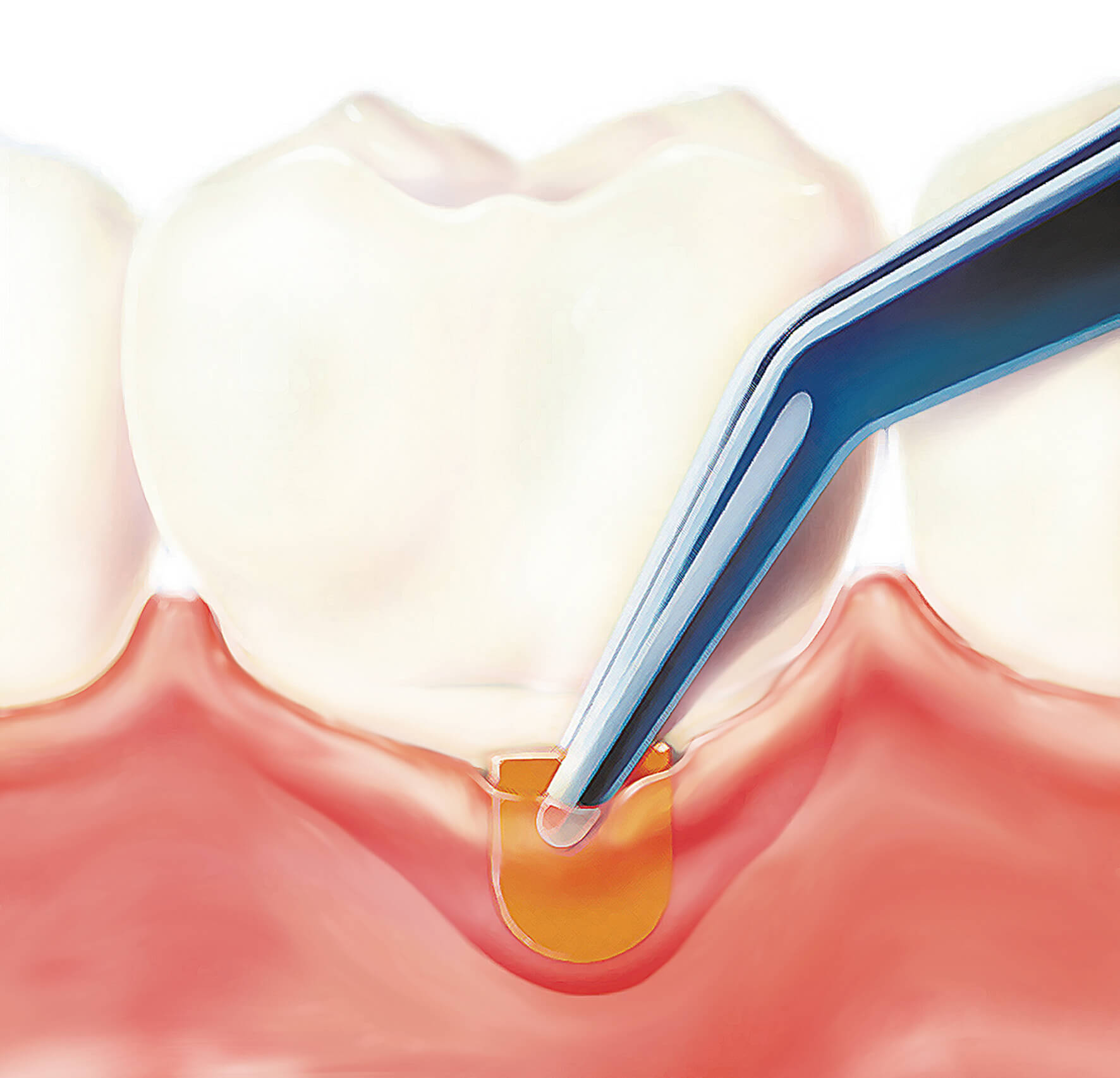 What is Periochip? | News | Dentagama