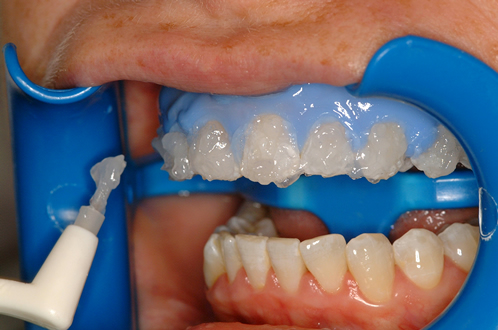 Professional teeth whitening gel