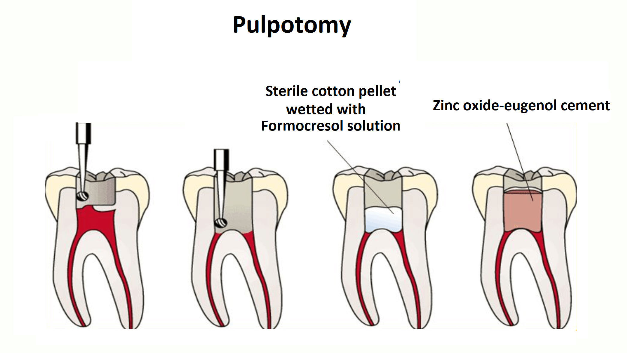 What Is Pulpotomy News Dentagama