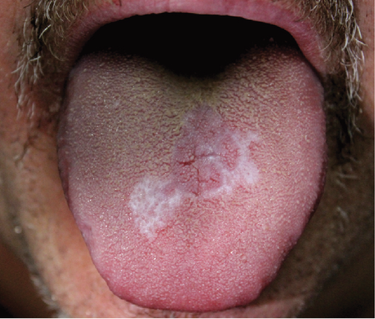 oral lichen planus cheek