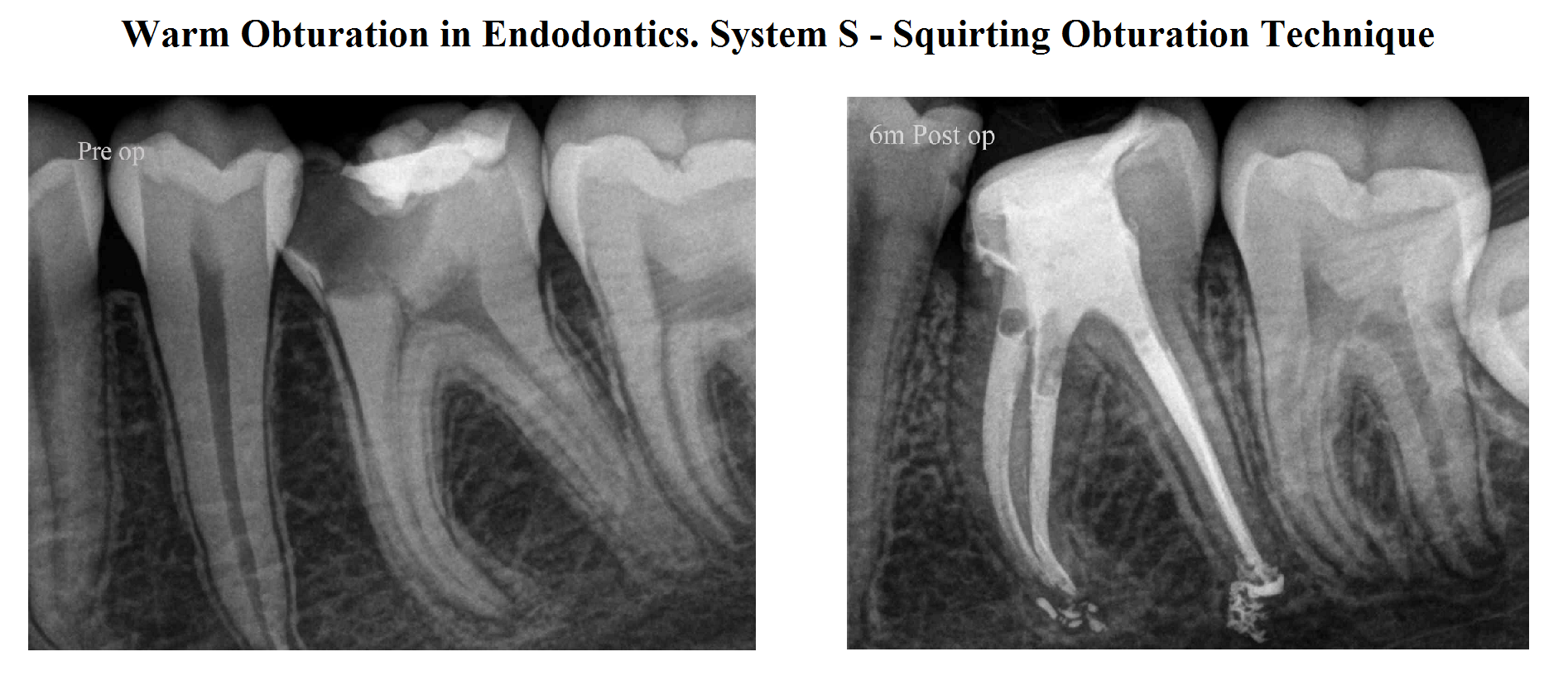 System S Squirting Obturation Technique In Endodontics News Dentagama