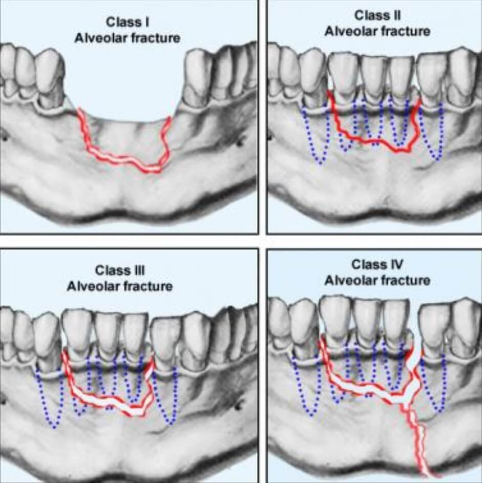Types Of Teeth Fractures