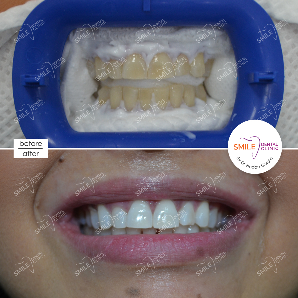 Teeth Whitening Dubai Dentagama