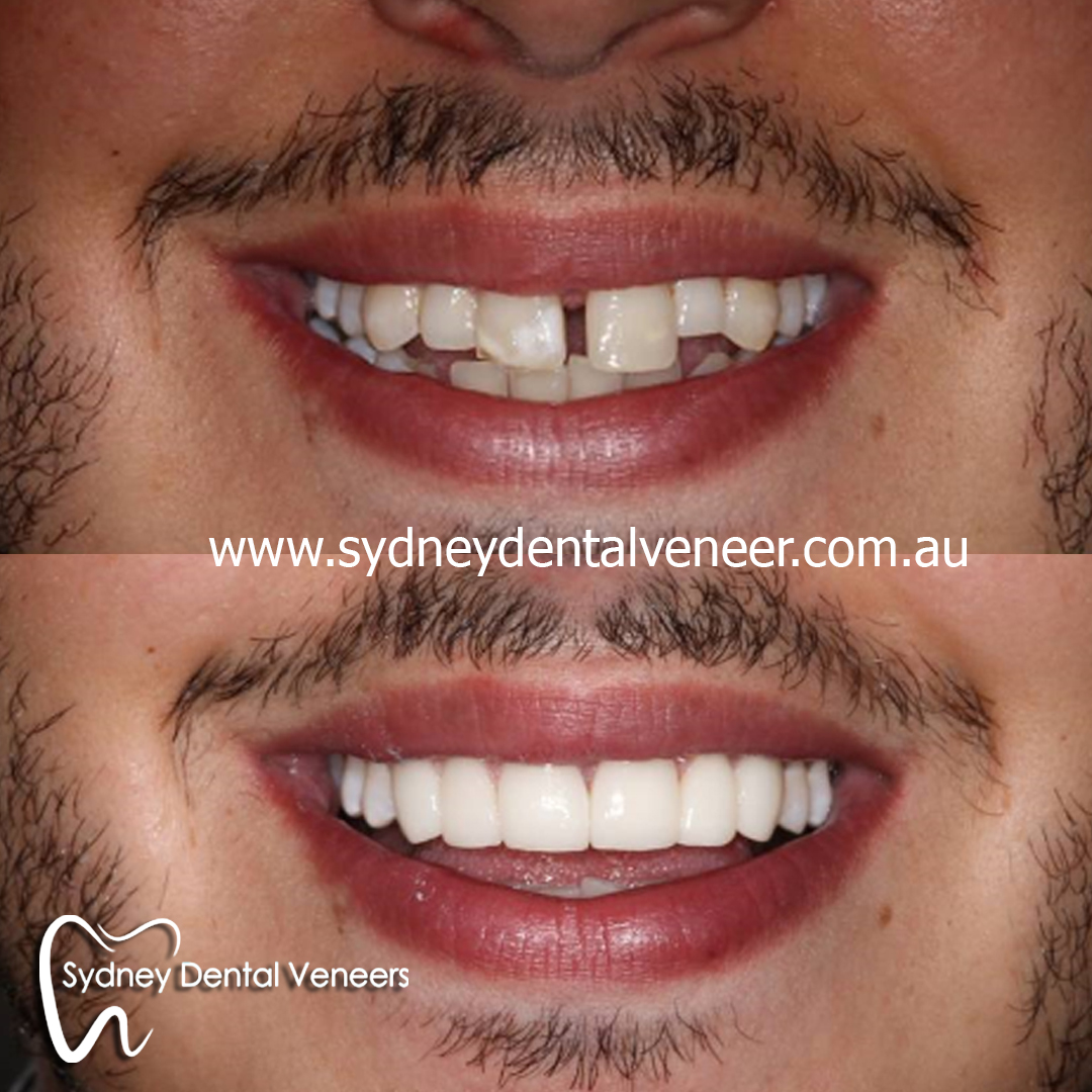 Dental Veneers Dentagama