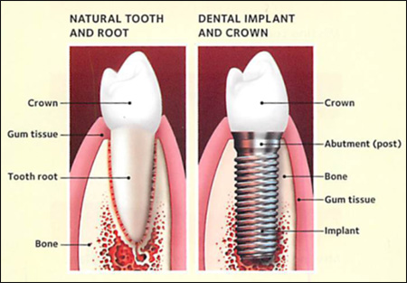 Mini Dental Implants Vs Regular Dental Implants