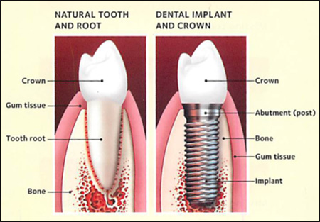 implant dental implants teeth tooth root missing natural solutions crown failure dentist vs cost form surgery procedure gum dentagama prevent