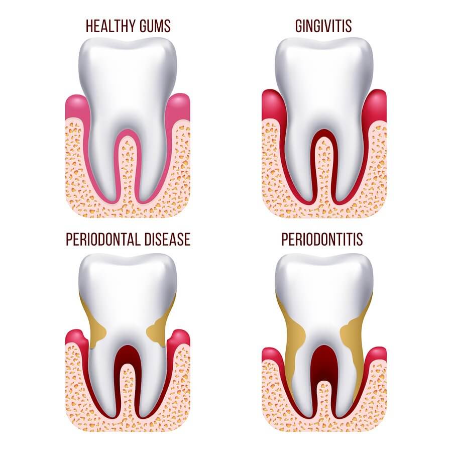 Gum Diseases Differences Between Gingivitis And Periodontitis News 