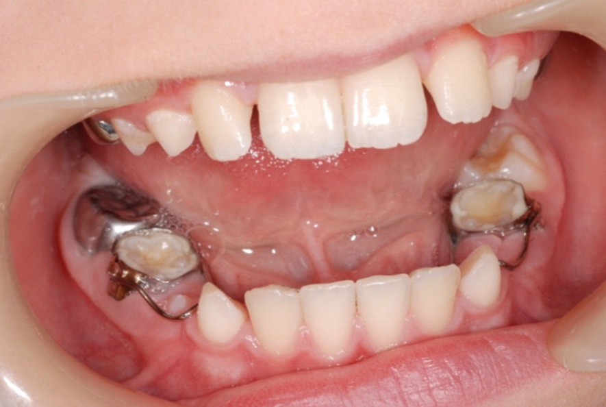 Space maintainers in dentistry | News | Dentagama