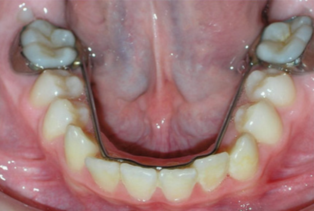 Space Maintainers In Dentistry News Dentagama