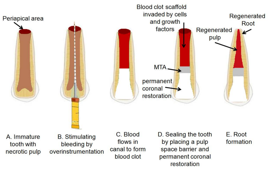 root endo