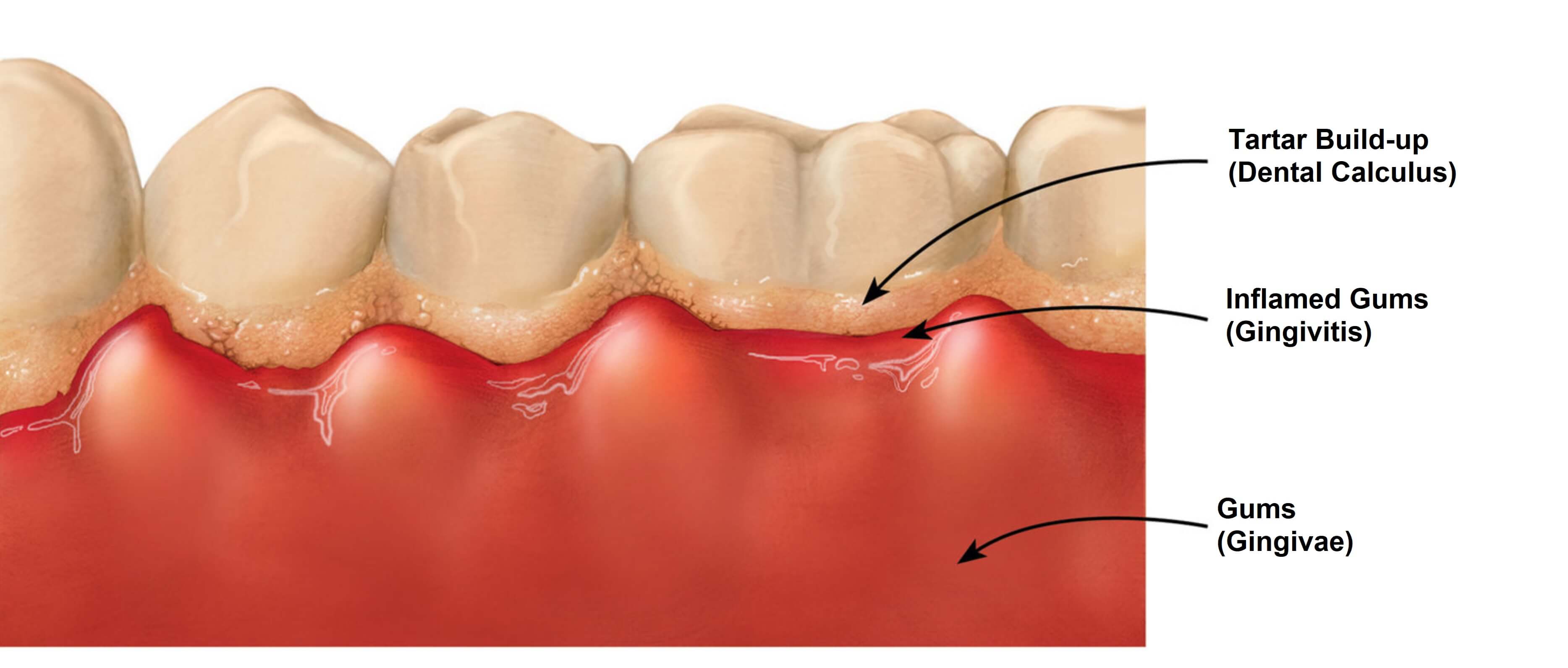 severe calculus buildup in mouth