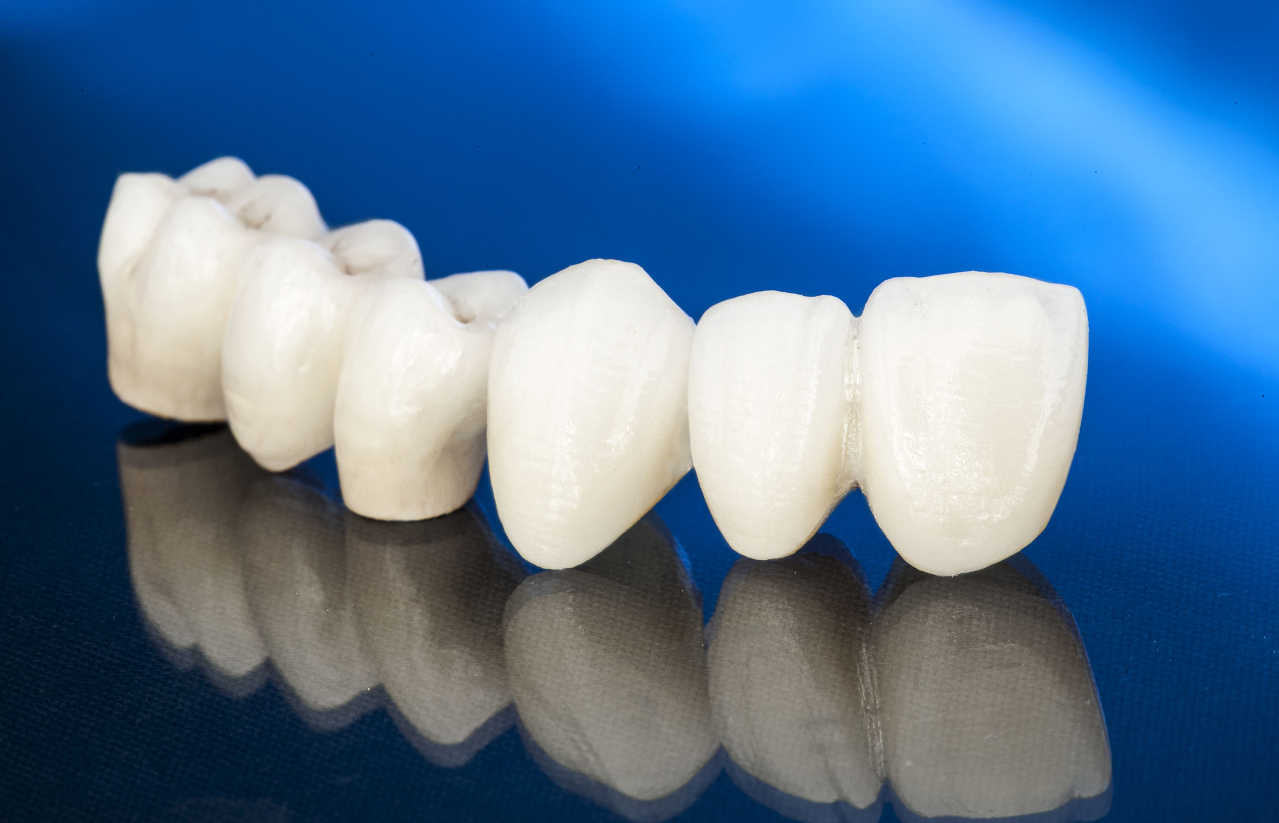 All Ceramic Crowns London Dental Implant Dentagama