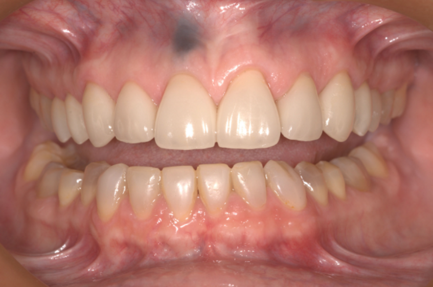 PDF) An amalgam tattoo on the oral mucosa related to a dental prosthesis |  Carlos Guillén - Academia.edu