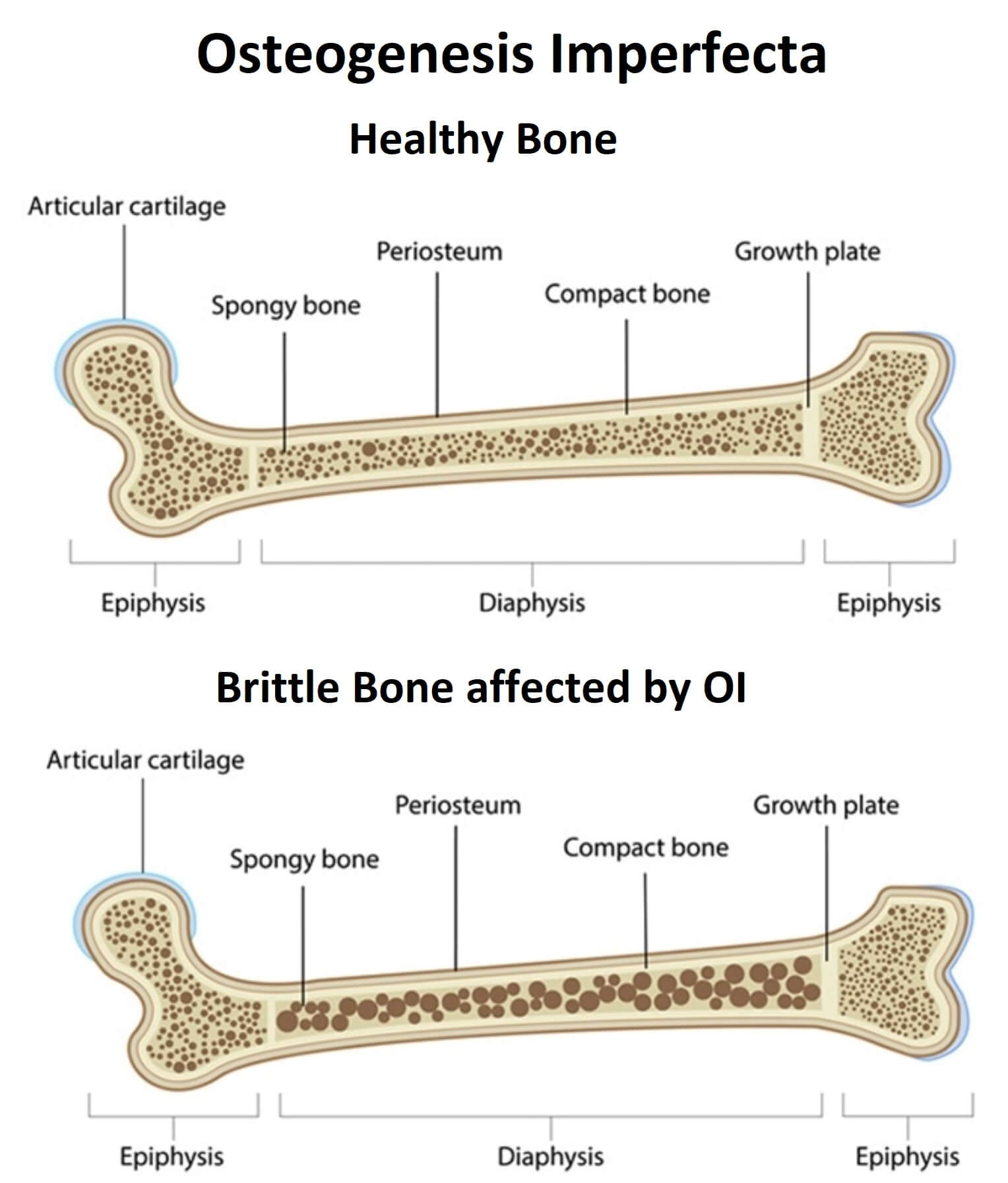 Brittle bones. Несовершенный остеогенез 3 степени. Несовершенный остеогенез 1 типа. Остеогенезис имперфекта. 3 Тип несовершенного остеогенеза.