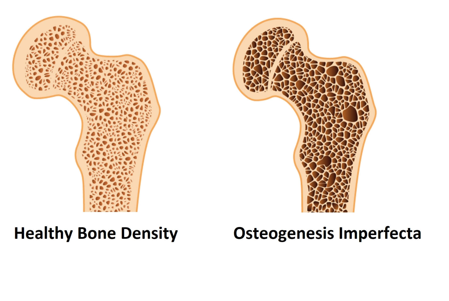 Al bone. Остеопороз. Остеопоротические переломы. Детский остеопороз. Ломкие кости.