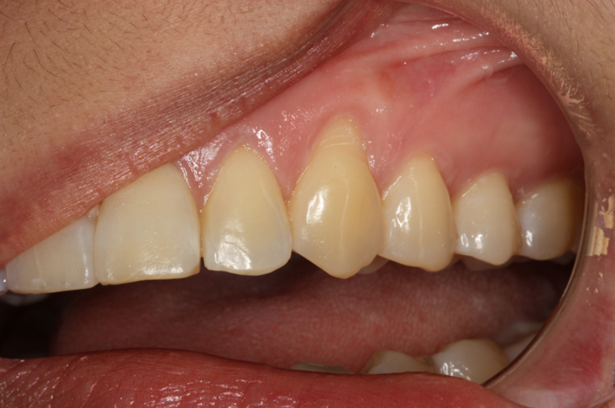 Uforudsete omstændigheder åbning noget Why overbrushing your teeth can be dangerous? | News | Dentagama