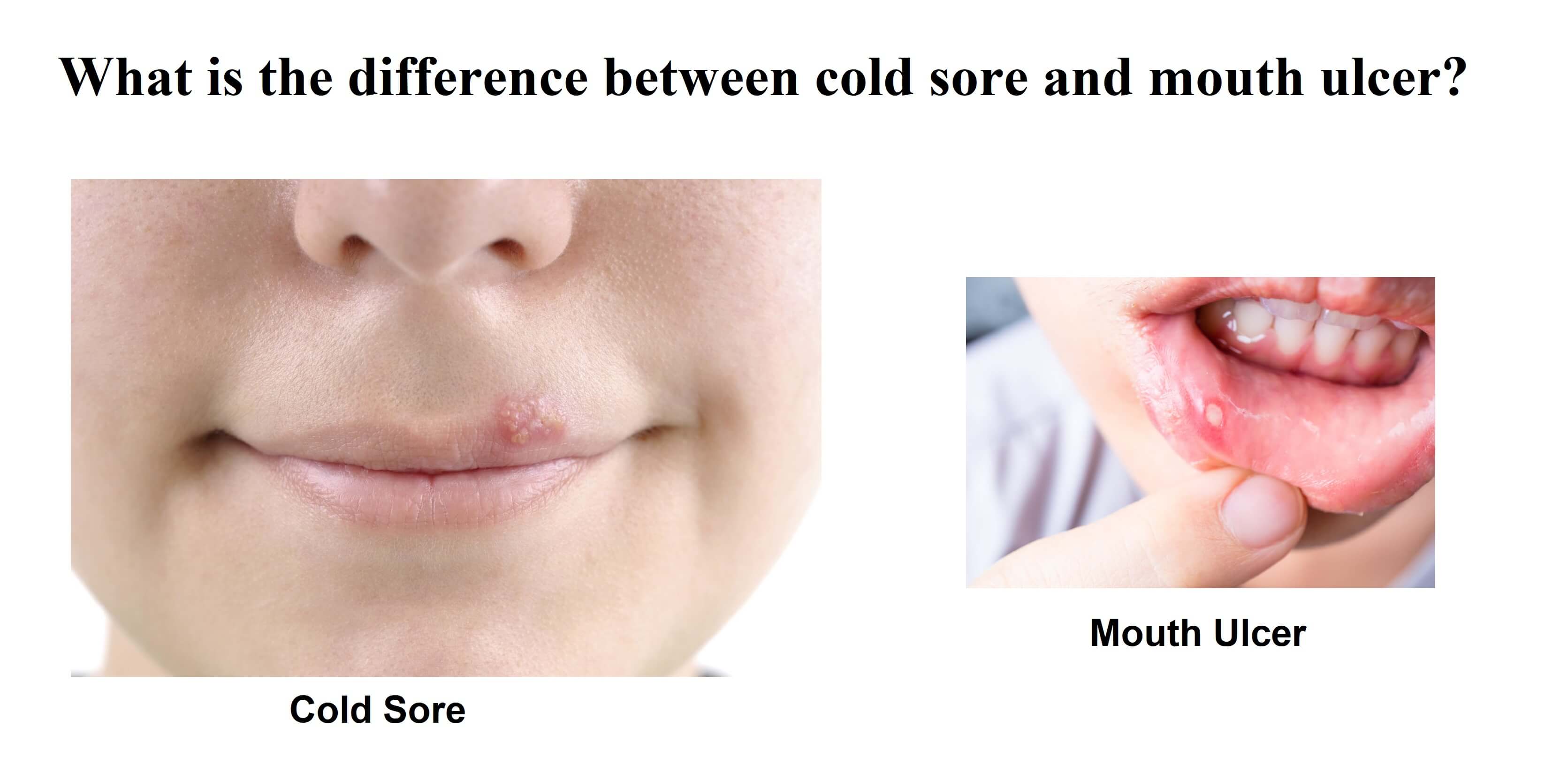 What Is The Difference Between Cold Sores And Mouth Ulcers News Dentagama