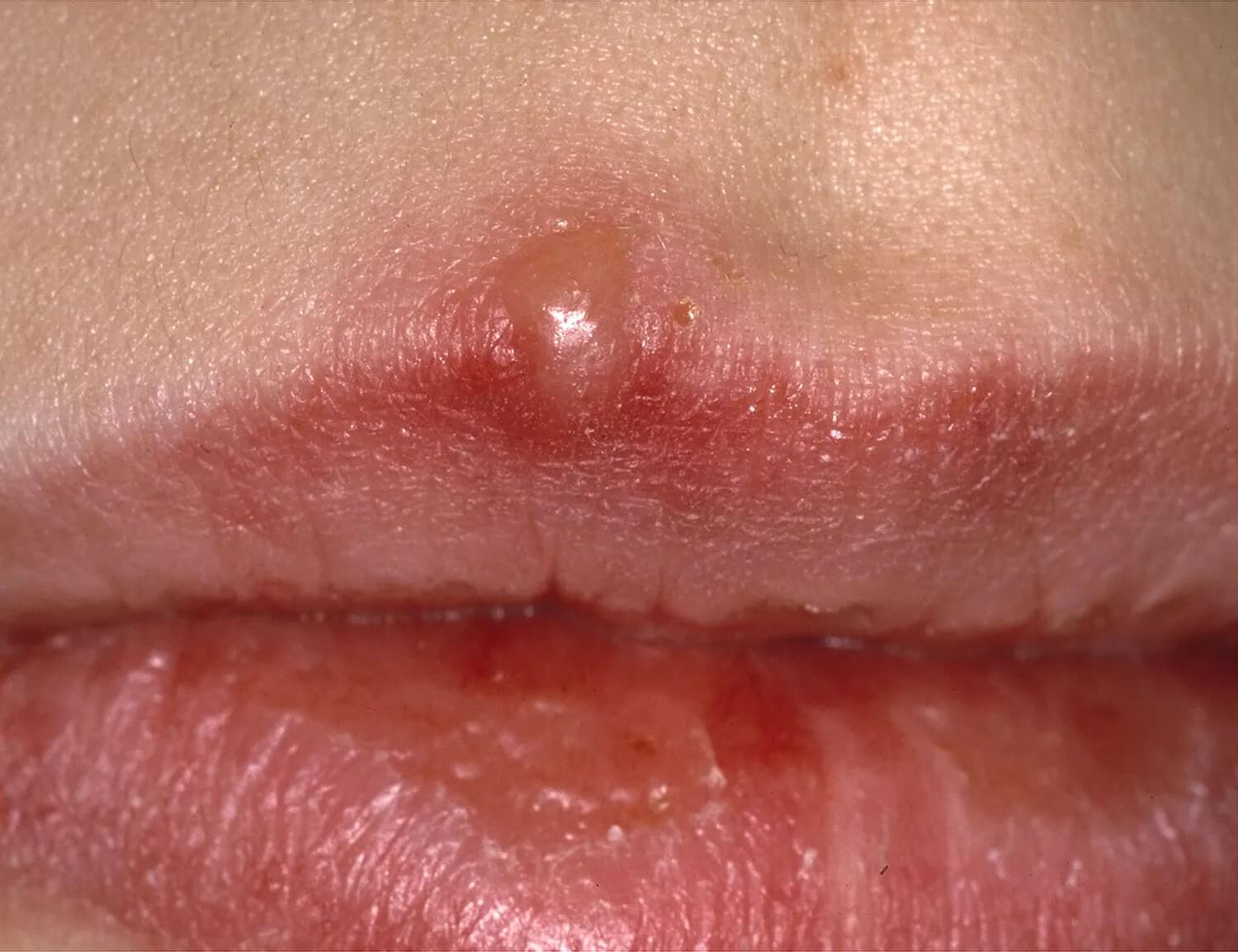 What is the difference between cold sores and mouth ulcers  News  