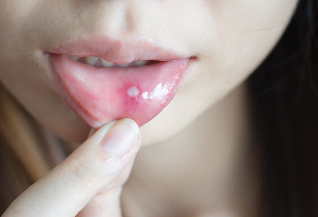 What Is The Difference Between Cold Sores And Mouth Ulcers News Dentagama