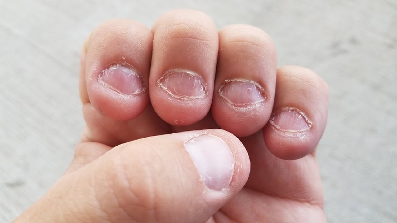 How to Stop Kids From Biting Their Nails for Good | NewFolks