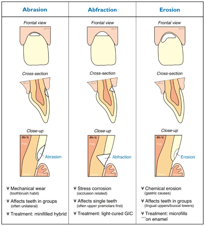 Tooth Abrasion Vs Erosion