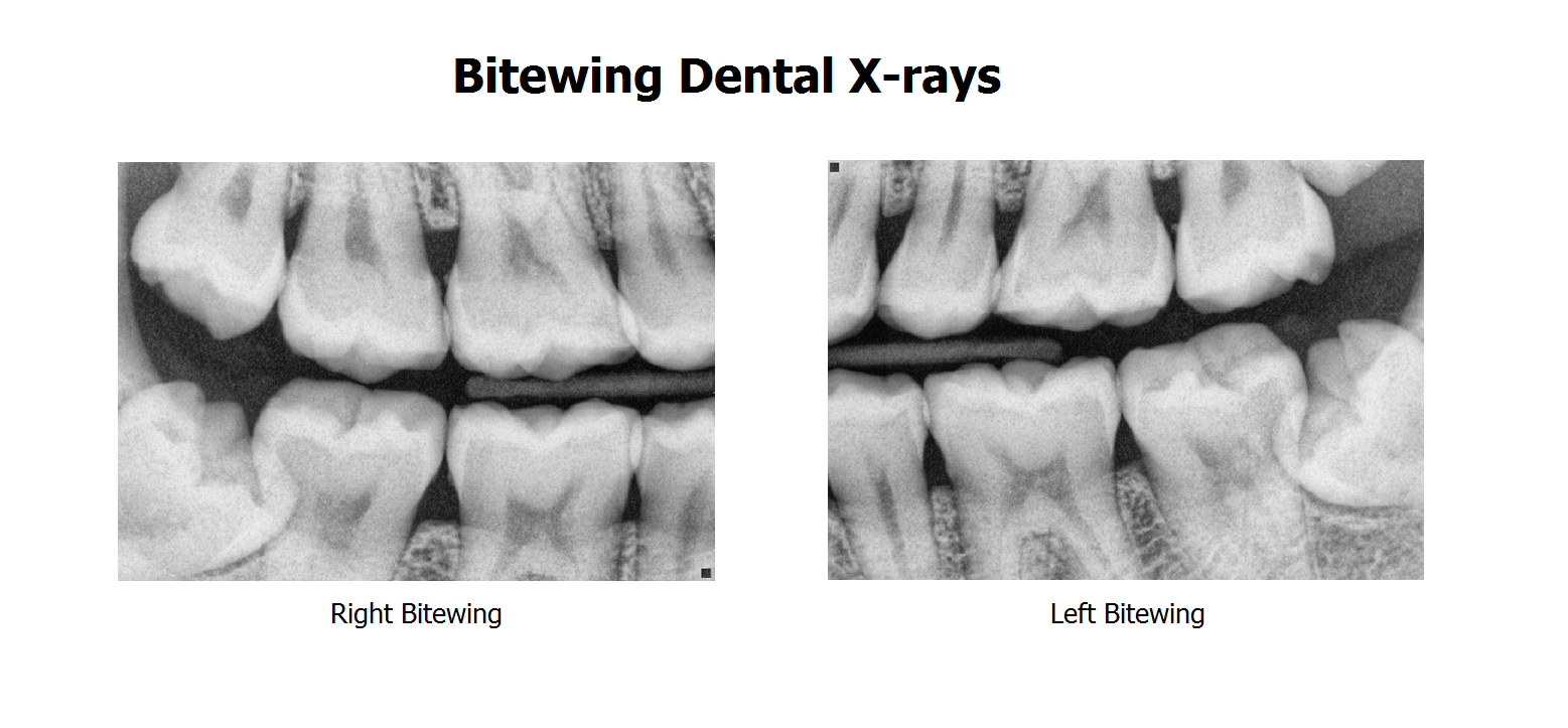 Taking Bitewing Dental X Rays