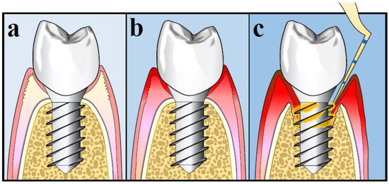 Peri-implant Mucositis | News | Dentagama