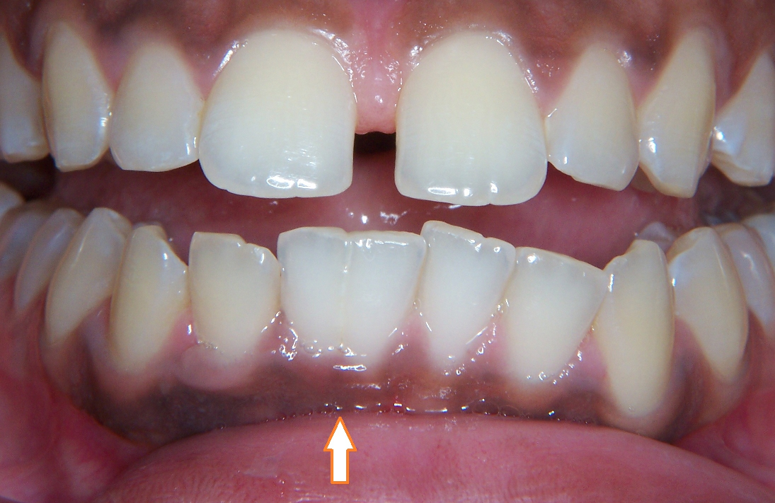 Fusion Teeth Pictures to Pin on Pinterest - PinsDaddy