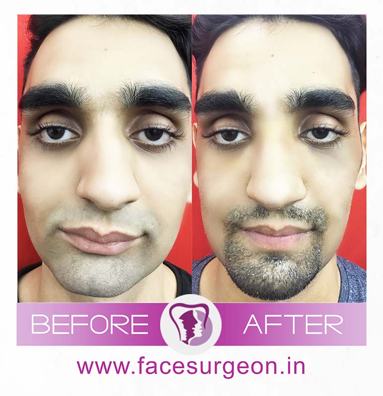 Orthognathic Jaw Surgery In India Richardsons Dental and Craniofacial