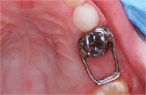 Space maintainers in dentistry | News | Dentagama