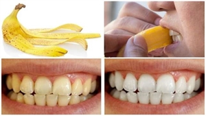 Is banana peel teeth whitening effective? | News | Dentagama