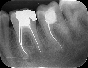 Silver points in root canal treatment and endodontics