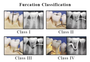 What is Furcation defect?